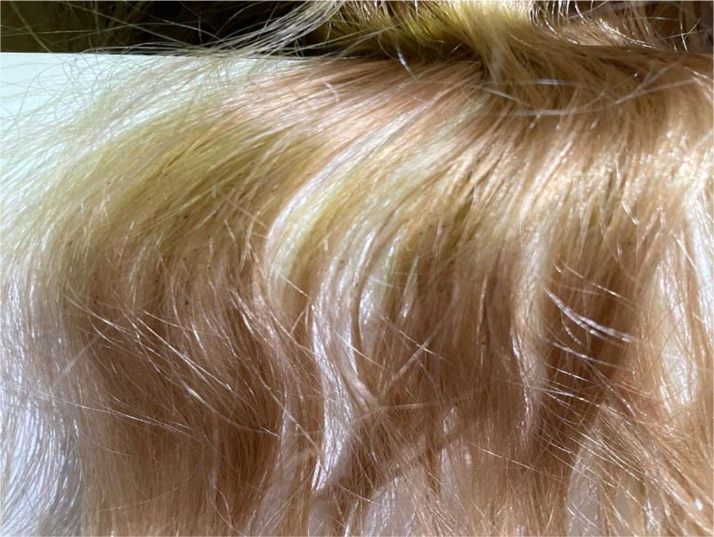 Fig. 2 Dermatoscopy of hair affected by black piedra (× 20)