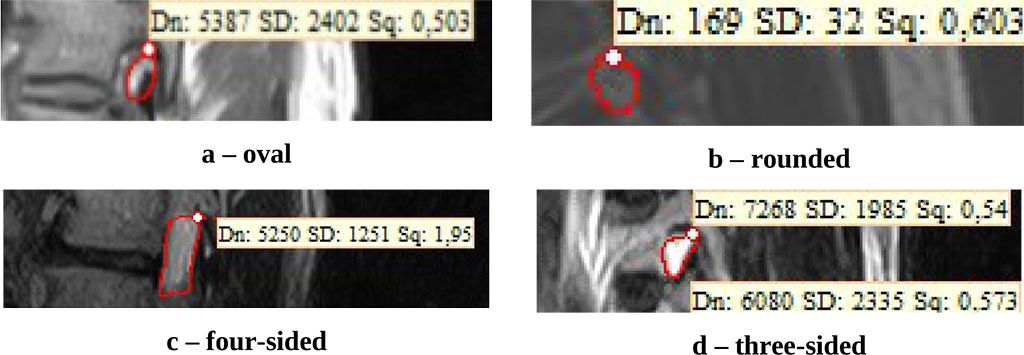 Figure 1. IVF shapes