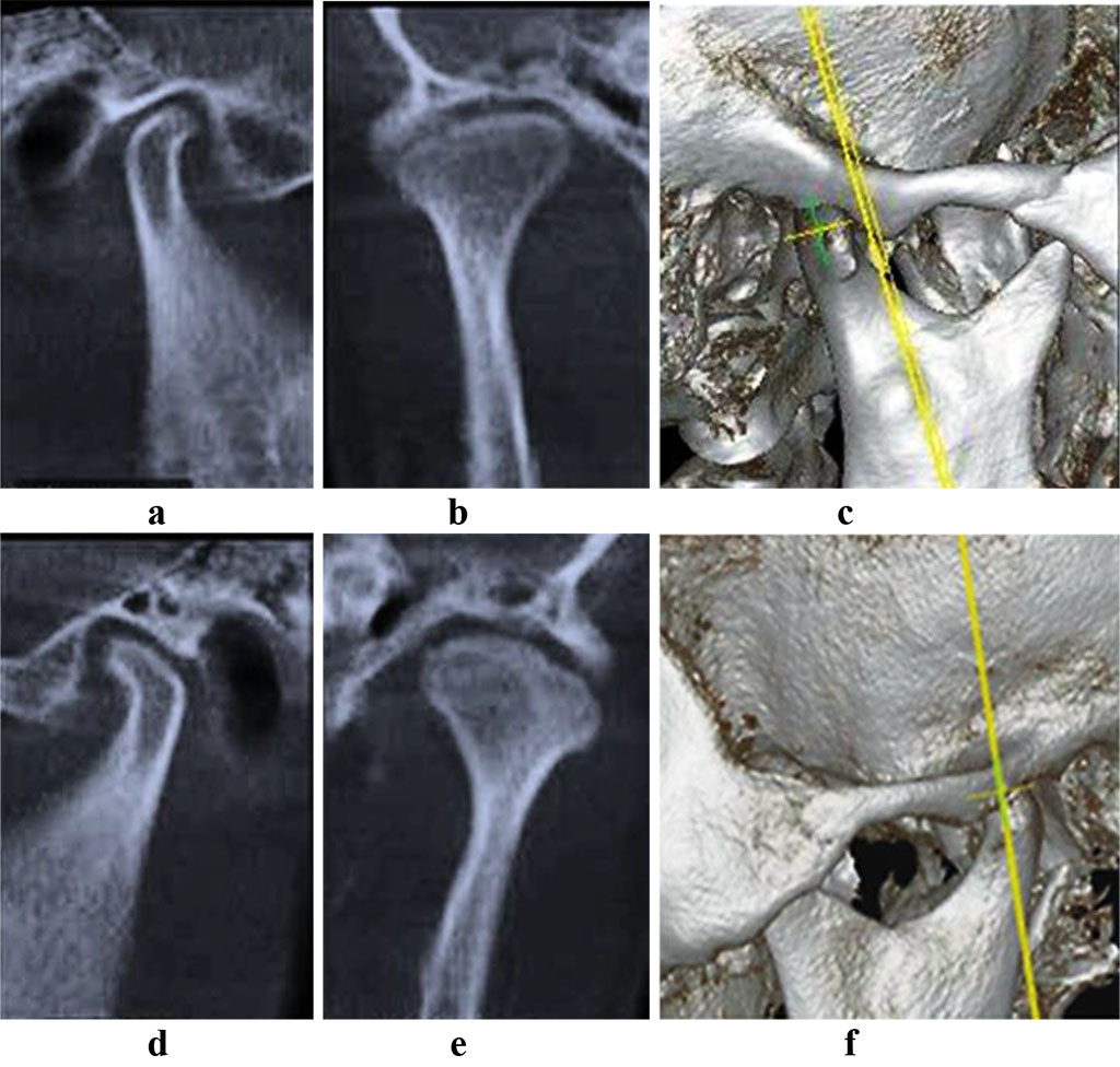 Fig. 10. Patient V., CBCT, right (a-c) and left (d-f) TMJ, mouth closed; following splint treatment