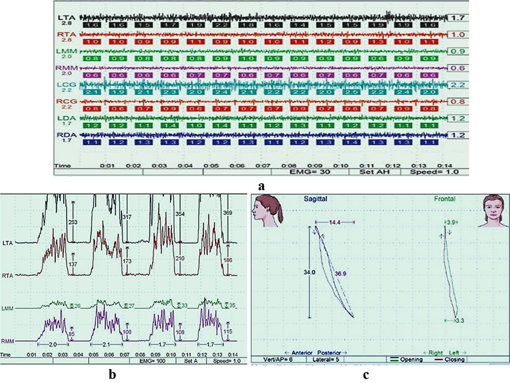Fig. 12. Patient V., masticatory muscles electromyogram, at physiological rest (a) and through maximum compression (b), kinesiograms of the lower jaw movement, transversal and sagittal (c) planes, following splint treatment