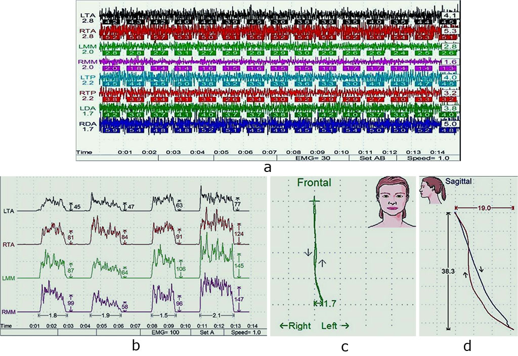 Fig. 4. Masticatory muscles electromyogram, physiological rest (a) and maximum compression (b); lower jaw movement kinesiogram, transversal (c) and sagittal (d) planes.