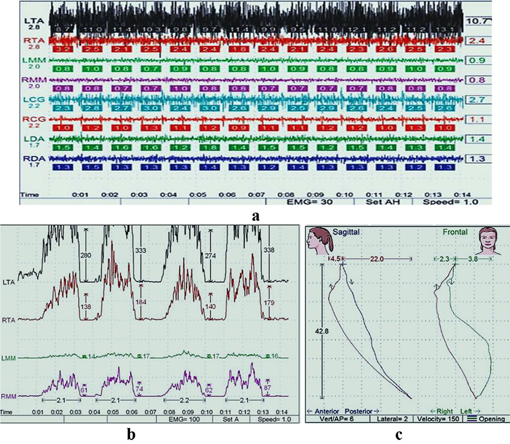Fig. 8. Patient V., electromyogram of the masticatory muscles at physiological rest (a) and at maximum compression (b), kinesiograms of the lower jaw movements in the transversal and sagittal (c) planes