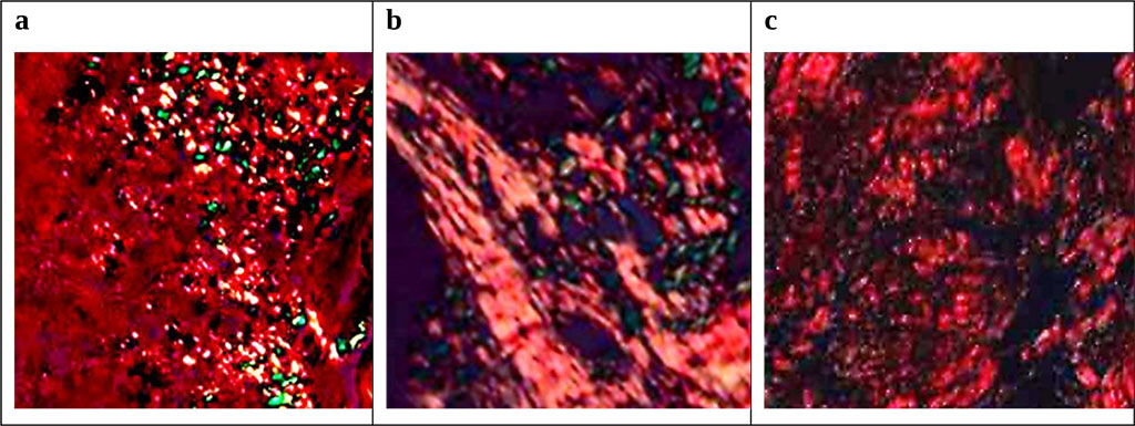 Figure 6. Morphological picture of gum tissue in patient S., 15 y.o., with deep distal bite (K07.20): a – initial status; b – status after conservative anti-inflammatory therapy; c – status following comprehensive dental treatment. Staining with 0.1% SiriusRed F3BA solution with picric acid (=500).