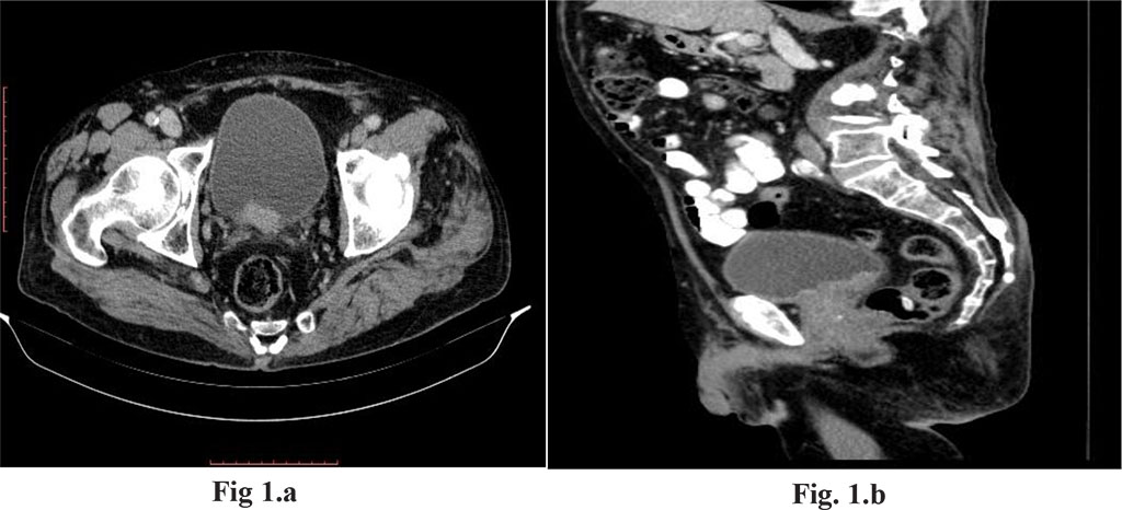 Parietal bladder changes
