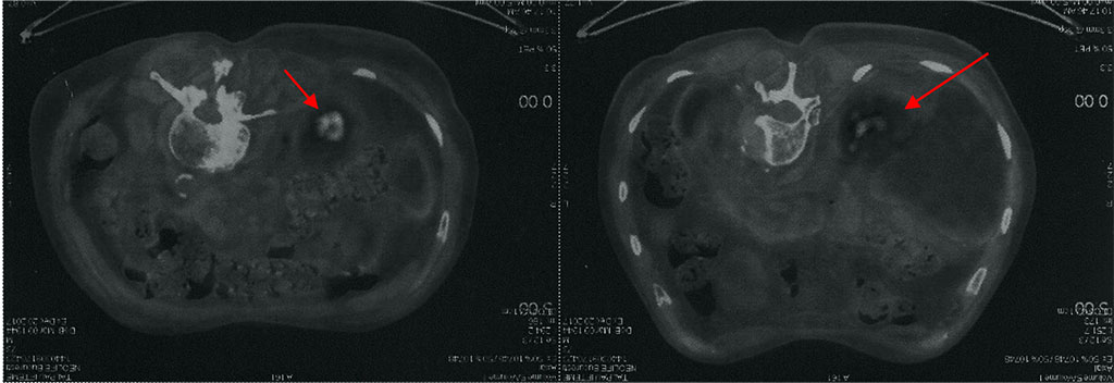 Fig. 2. PET / CT image active metabolic node active upper right lobe (left) and metabolically active pseudo-nodular lesion inferior lobe right (right)