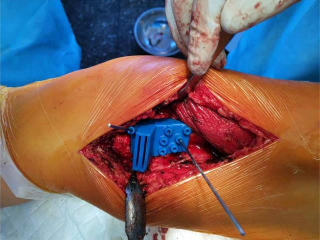 Figure 4. Appearance of INS in the operative wound
