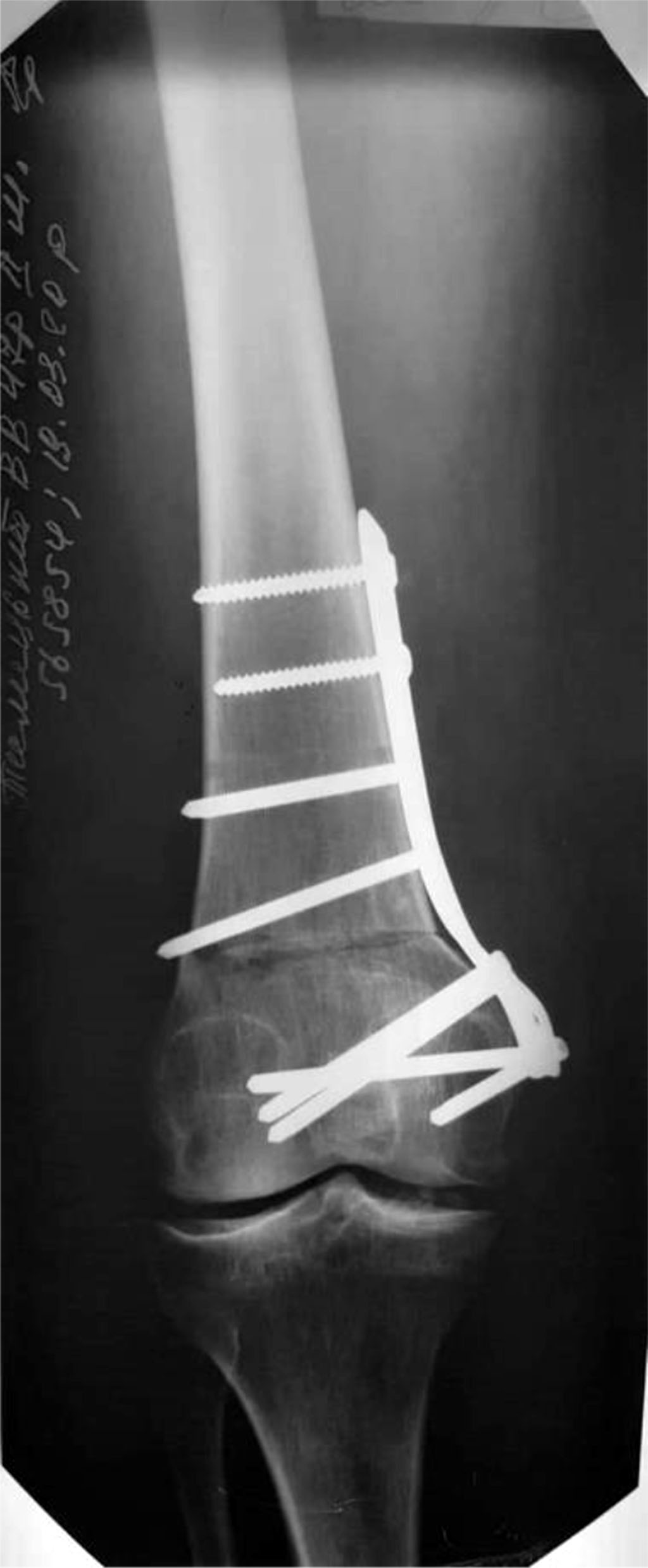 Figure 6. X-ray of the knee joint after carrying out supracondylar resection varus osteotomy of the right femur. With MOC LCR - plate.