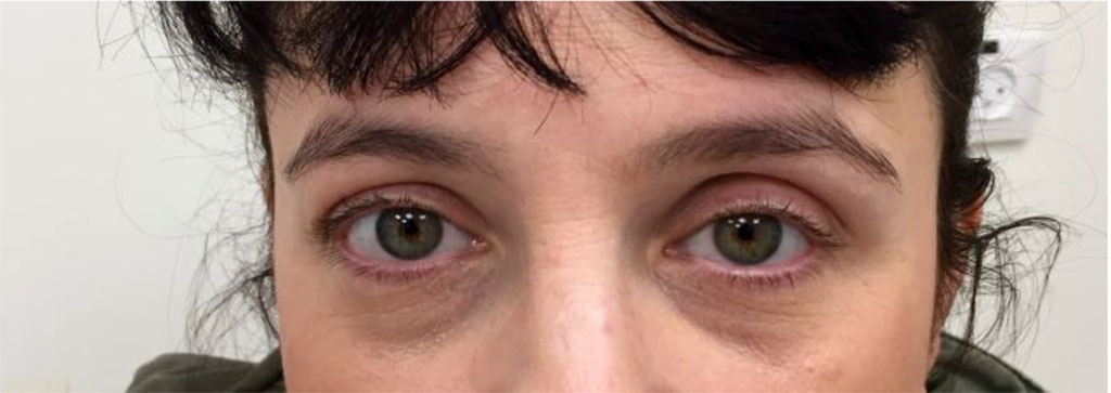 Figure 1: Clinical photo on presentation demonstrating hypoglobus and superior sulcus defect on the left side