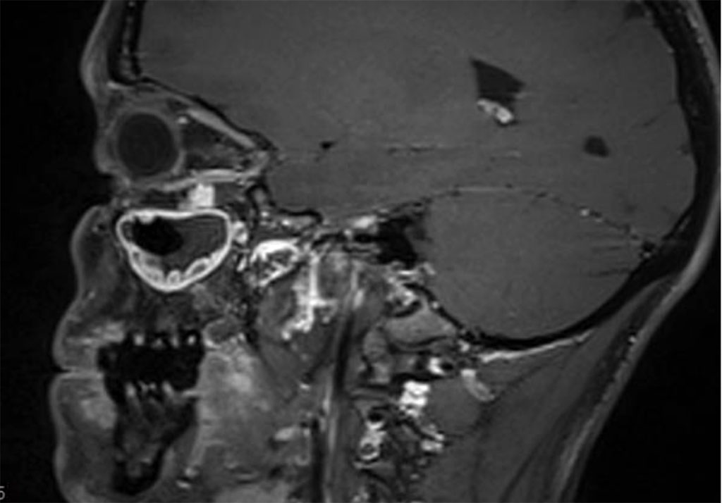 Figure 2b: Sagital MR T1 demonstrating left inferior orbital lesion 