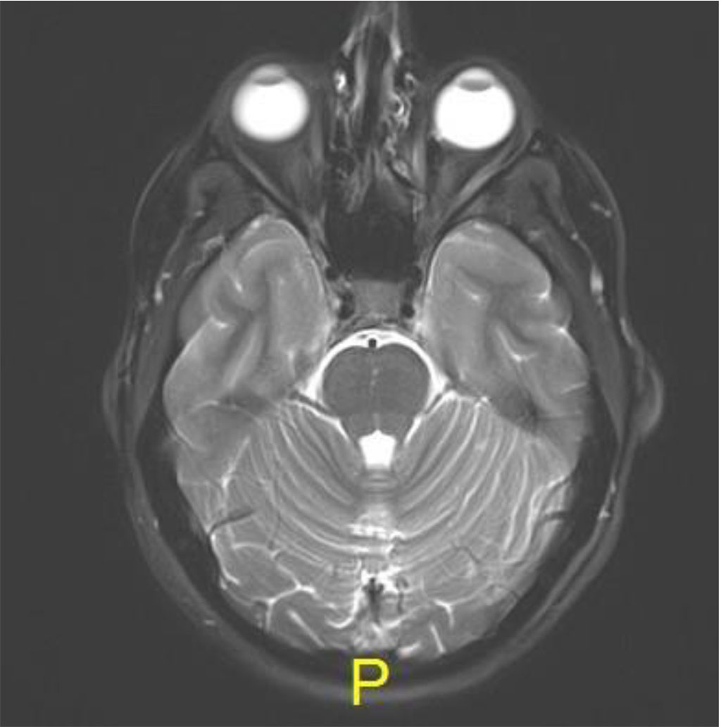 Figure 4a: Axial MR T2: resolution of lesion 