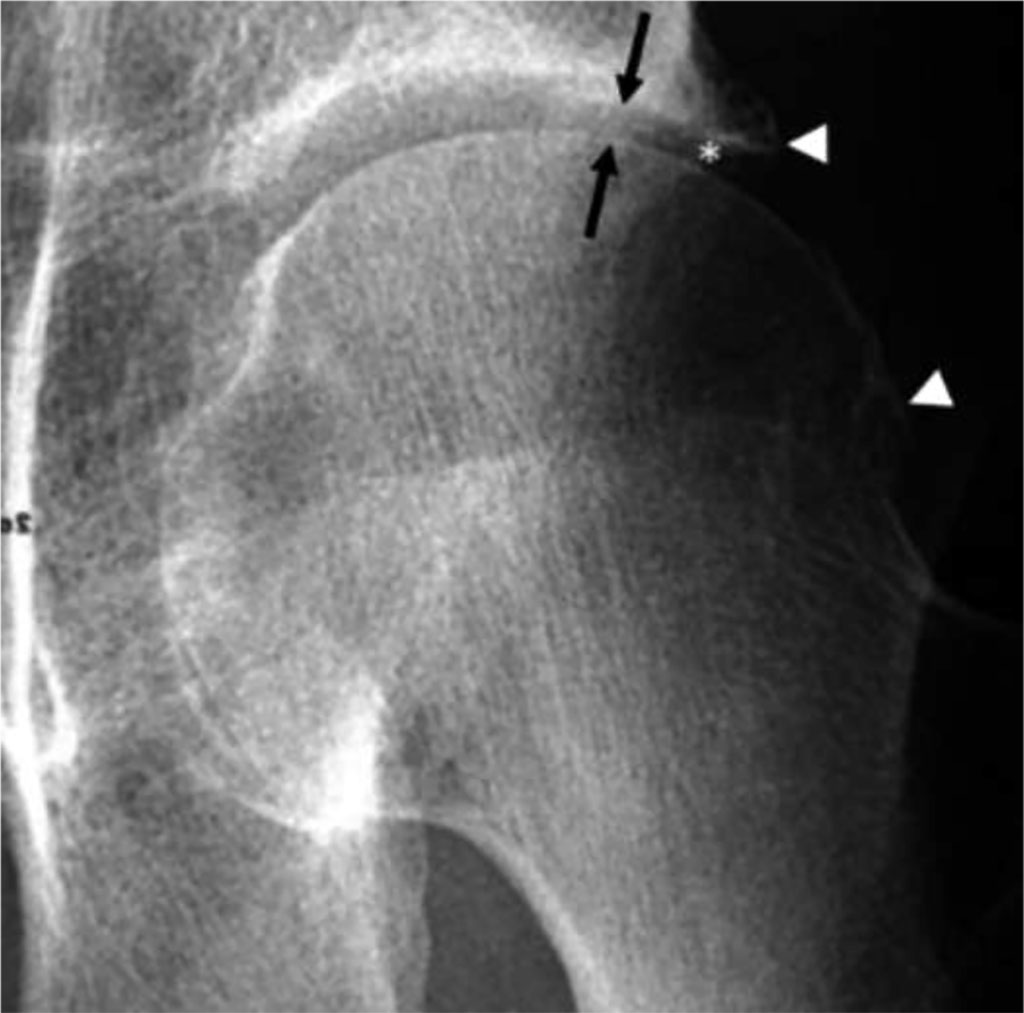 Fig 2. Osteoarthritis of the left hip. AP RTG demonstrates lateral joint space narrowing (arrows) and marginal osteophytes (arrowheads) [7].