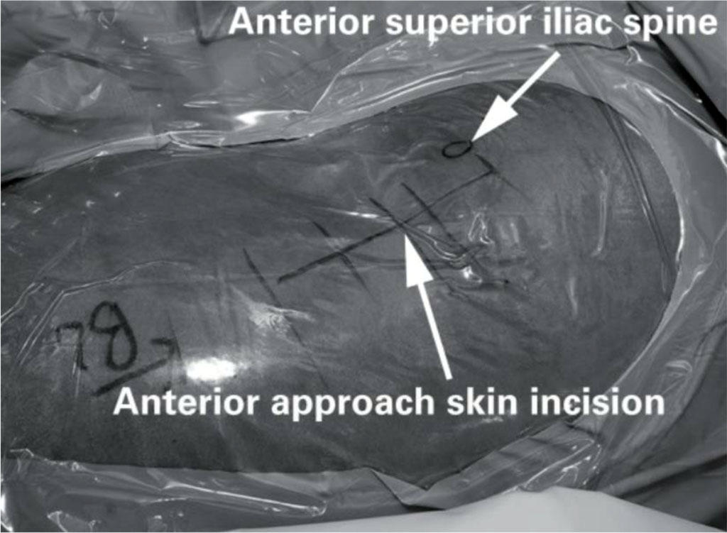 Fig 3. The skin incision used for the direct anterior approach to the hip [43].