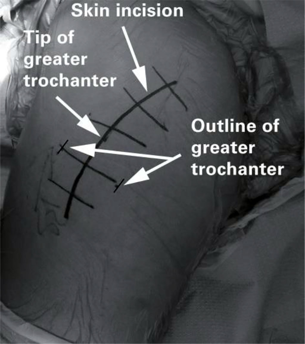 Fig 5. The skin incision used for a posterior approach to the hip [43].