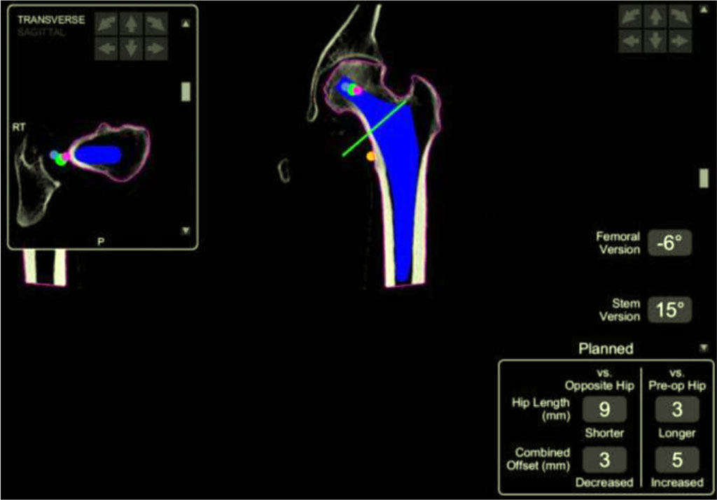 Fig 7. Screen displaying preoperative confirmation of the femoral stem size, offset, and version prior to cutting the femoral neck. [49].