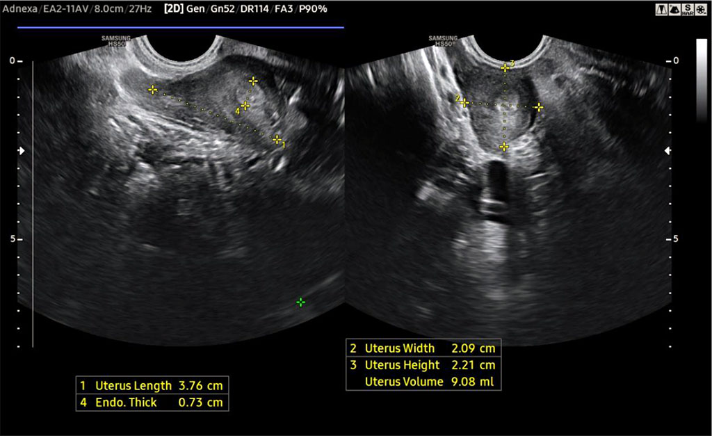 Figure 1. Vestigial uterus visualised on ultrasound