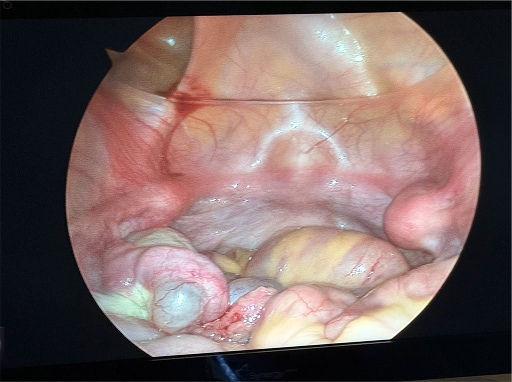 Figure 2. Vestigial uterus visualised by laparoscopy