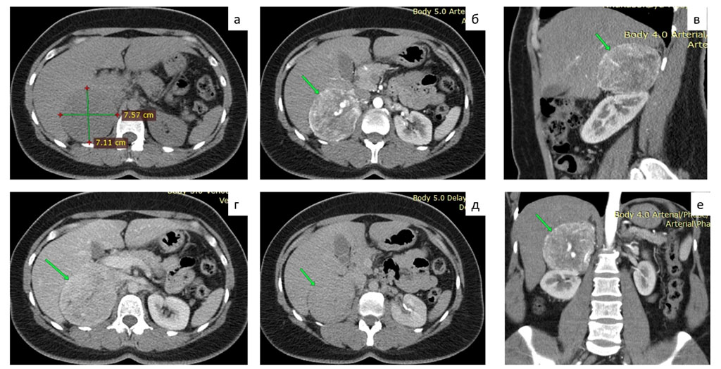 Figure 1. MSCT of the abdomen with contrast: a - native phase, b, c, f - arterial phase, d - venous phase, e - delayed phase.