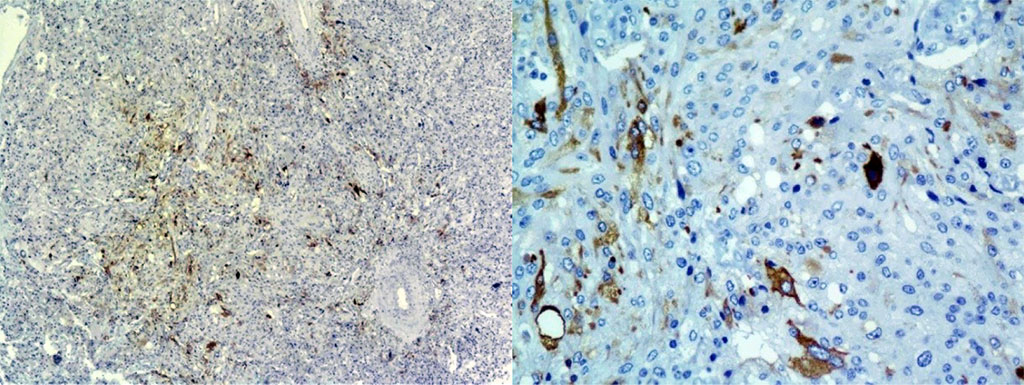 Figure 3. IHC study of an adrenal tumor: Calcitonin+ pheochromocytoma cells, focal focal expression: x40; x200