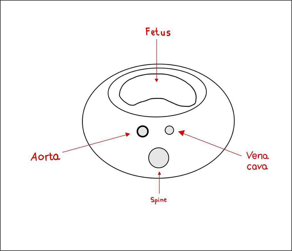 Figure 1. Aorto-venous syndrome [Authors' own figure].