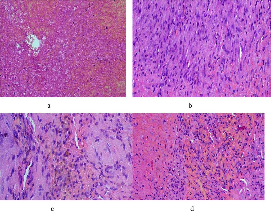 Figure 4. Morphological picture of a pseudoaneurysm – see explanations in the text (hematoxylin-eosin, X100)
