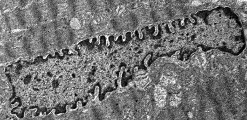 Figure 2. Histopathological changes in the nucleus of contractile cardiomyocytes: overt primary hypothyroidism on the 29th day from the start of the experiment. Magnification 2400. TEM.