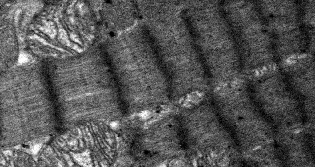 Figure 4. Histopathological changes in the myofibrils of contractile cardiomyocytes. Areas of overcontraction of myofibrils of contractile cardiomyocytes with the presence of contractures. Magnification 6600. TEM.