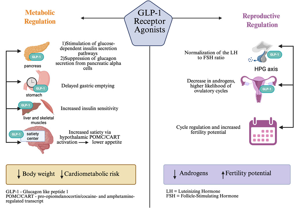 Figure 1. Pathophysiological mechanisms linking insulin resistance and hyperandrogenism in PCOS. Created in https://BioRender.com based on literature [5].