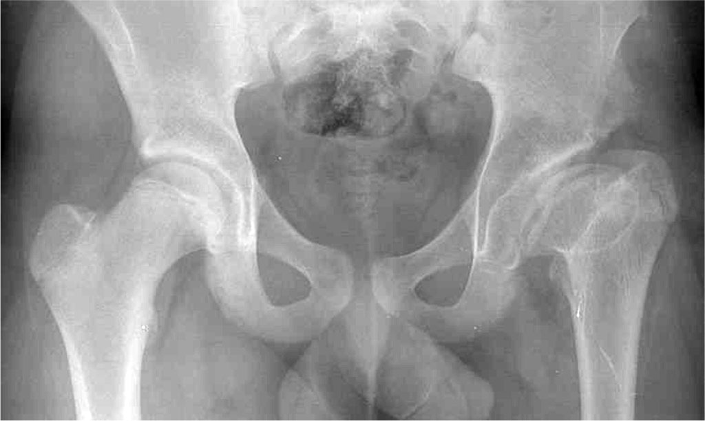 Fig. 1 Preoperative radiograph showing morphological sequelae of Legg-Calvé-Perthes disease in the left hip - oversized ellipsoid femoral head, GT elevation, shortened femoral neck, and mild acetabular dysplasia [49].