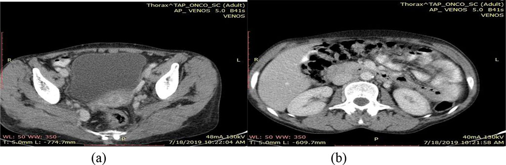 Fig.4. CT scan July 2019 - (a) Heterogeneous cervical image and (b) normal sized kidney with physiological secretion and excretion